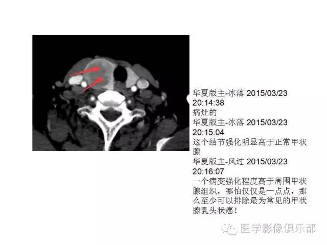甲状腺腺瘤与甲状腺癌的鉴别