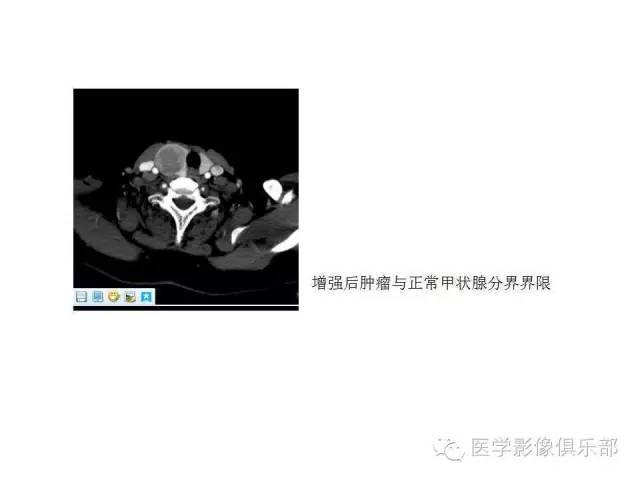 甲状腺腺瘤与甲状腺癌的鉴别