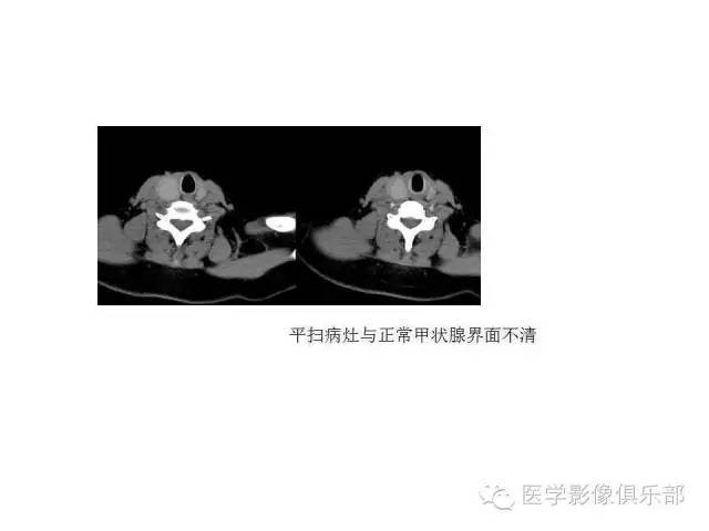 甲状腺腺瘤与甲状腺癌的鉴别
