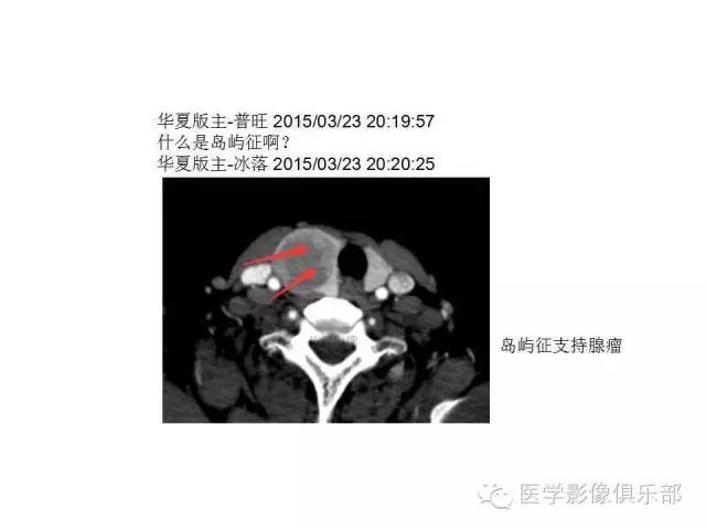 甲状腺腺瘤与甲状腺癌的鉴别