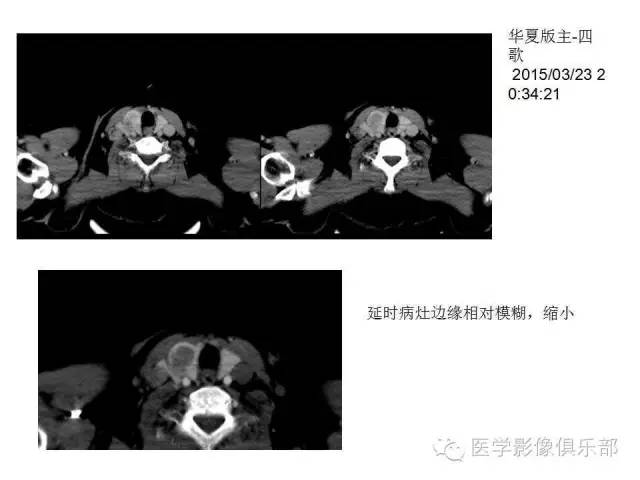 甲状腺腺瘤与甲状腺癌的鉴别