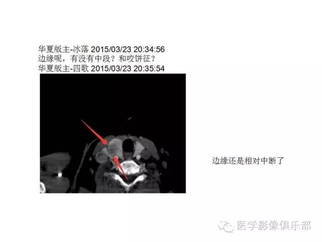 甲状腺腺瘤与甲状腺癌的鉴别
