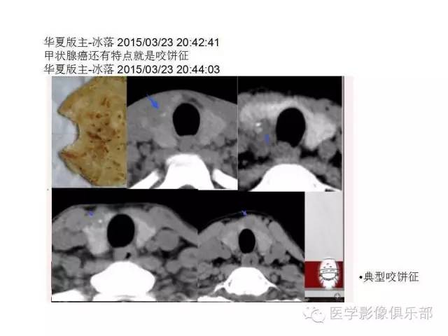 甲状腺腺瘤与甲状腺癌的鉴别
