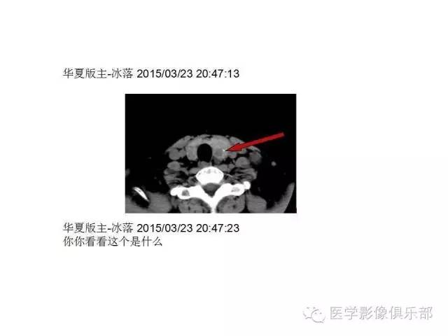 甲状腺腺瘤与甲状腺癌的鉴别