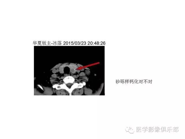 甲状腺腺瘤与甲状腺癌的鉴别