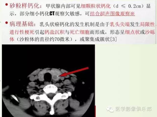 甲状腺腺瘤与甲状腺癌的鉴别