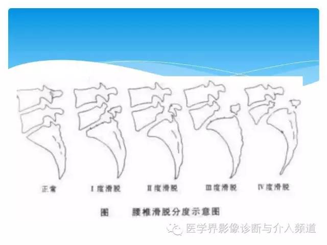 一眼看穿腰椎真性or假性滑脱