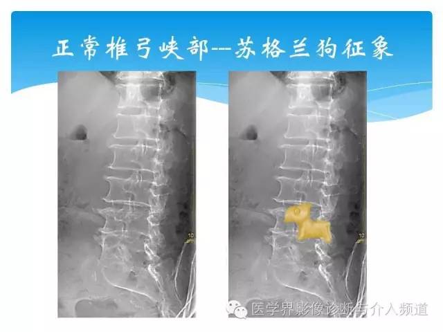 一眼看穿腰椎真性or假性滑脱