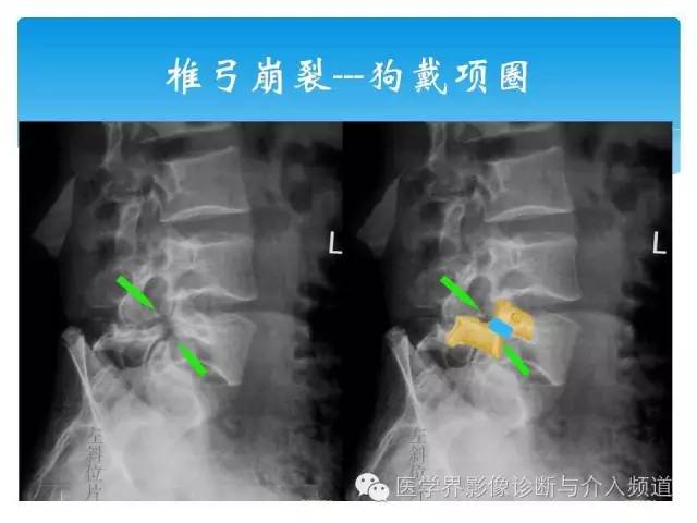 一眼看穿腰椎真性or假性滑脱