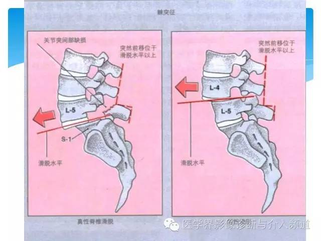 一眼看穿腰椎真性or假性滑脱