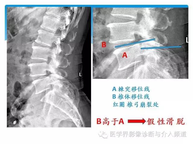 一眼看穿腰椎真性or假性滑脱