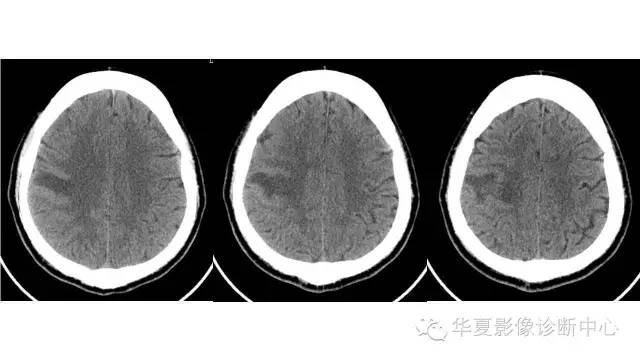 【病例】脑脓肿1例CT及MR影像表现