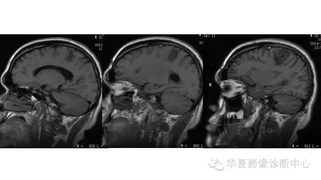 【病例】脑脓肿1例CT及MR影像表现 【病例】脑脓肿1例CT及MR影像表现