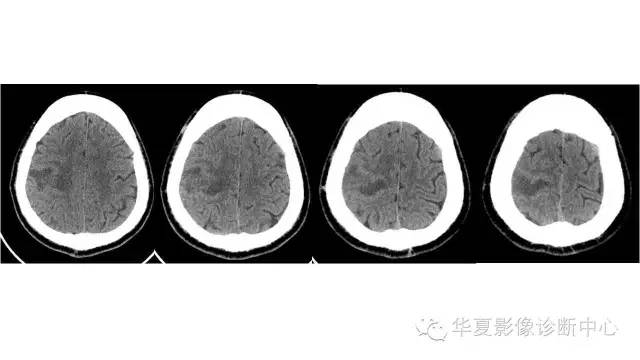 【病例】脑脓肿1例CT及MR影像表现 【病例】脑脓肿1例CT及MR影像表现