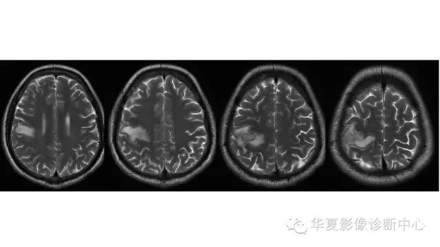 【病例】脑脓肿1例CT及MR影像表现 【病例】脑脓肿1例CT及MR影像表现