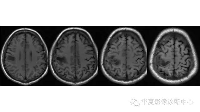 【病例】脑脓肿1例CT及MR影像表现 【病例】脑脓肿1例CT及MR影像表现