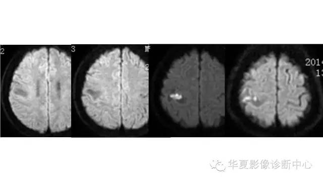 【病例】脑脓肿1例CT及MR影像表现 【病例】脑脓肿1例CT及MR影像表现