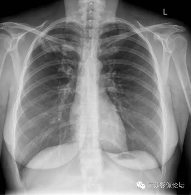 【双语病例】胸部原发后肺结核1例X线及CT影像表现