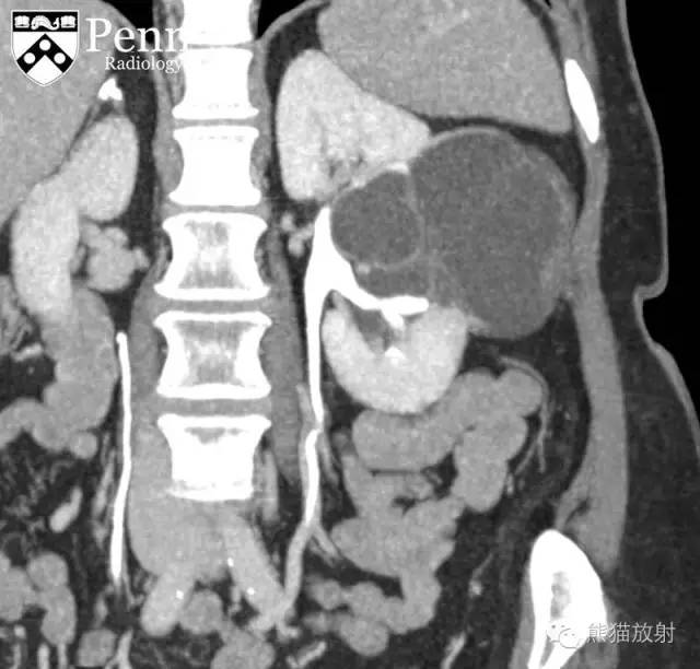 【双语病例】多房性囊性肾瘤1例CT影像表现 【双语病例】多房性囊性肾瘤1例CT影像表现