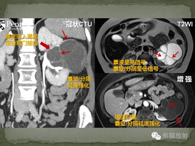 【双语病例】多房性囊性肾瘤1例CT影像表现 【双语病例】多房性囊性肾瘤1例CT影像表现