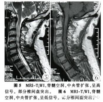 【病例】MRI诊断脊髓空洞引起夏科氏关节病1例