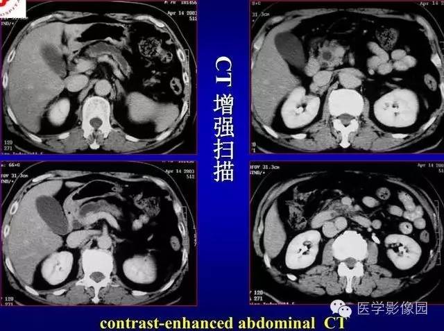 【PPT】胰腺少、罕见病变