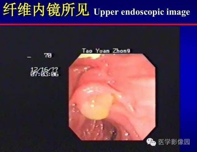 【PPT】胰腺少、罕见病变