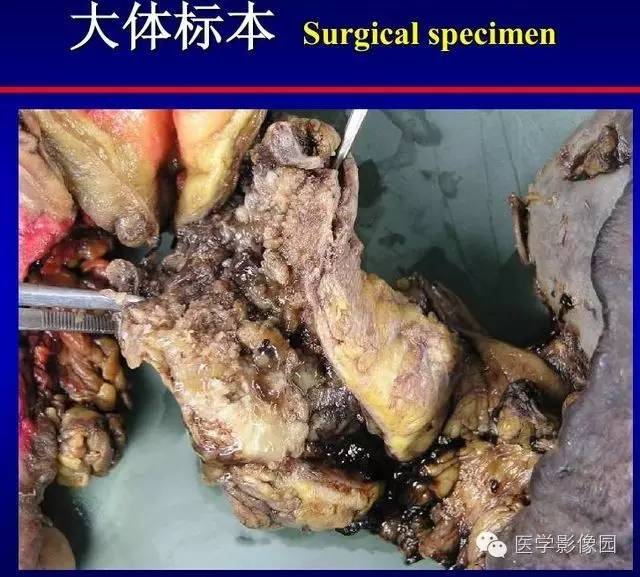【PPT】胰腺少、罕见病变