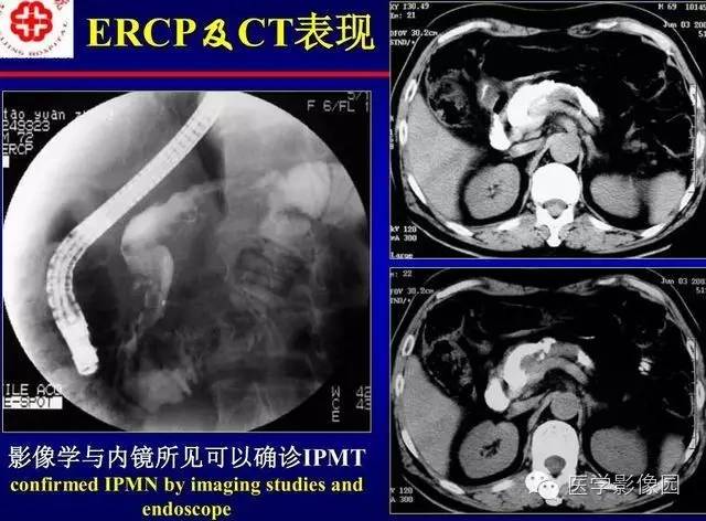 【PPT】胰腺少、罕见病变