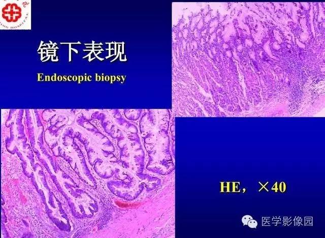 【PPT】胰腺少、罕见病变