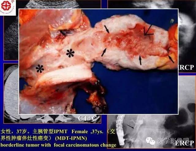 【PPT】胰腺少、罕见病变