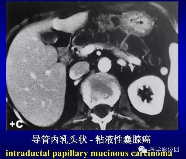 【PPT】胰腺少、罕见病变