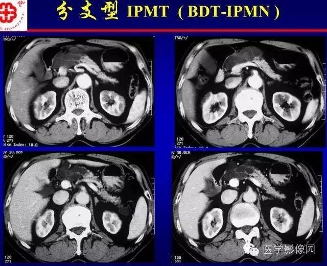 【PPT】胰腺少、罕见病变