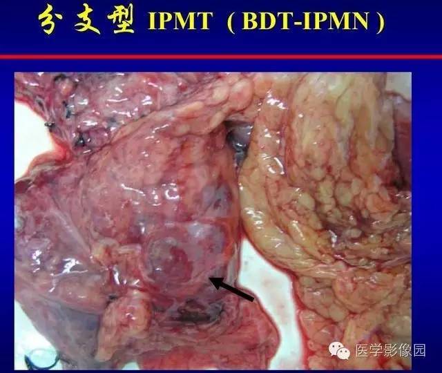 【PPT】胰腺少、罕见病变