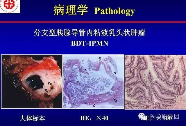 【PPT】胰腺少、罕见病变