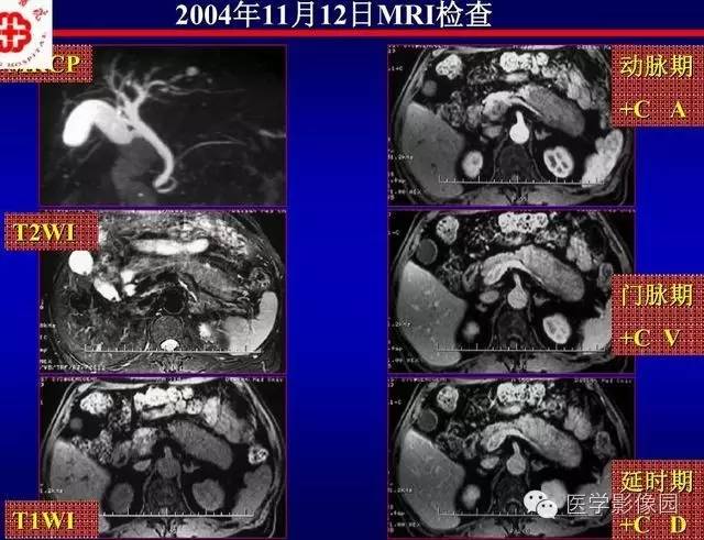【PPT】胰腺少、罕见病变
