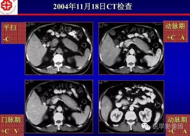【PPT】胰腺少、罕见病变
