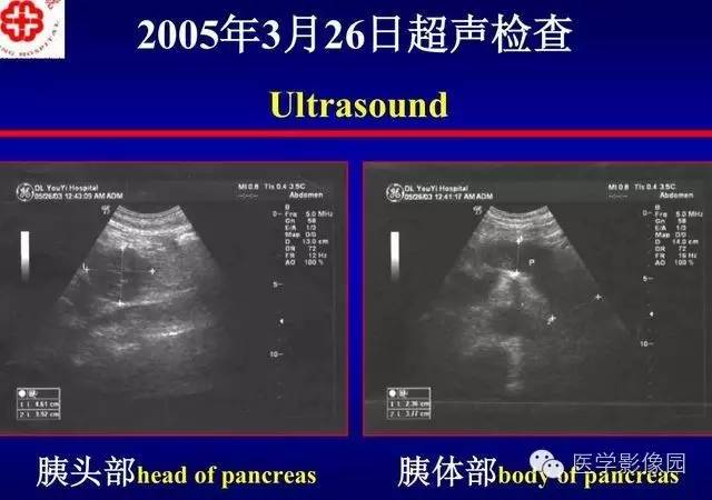 【PPT】胰腺少、罕见病变
