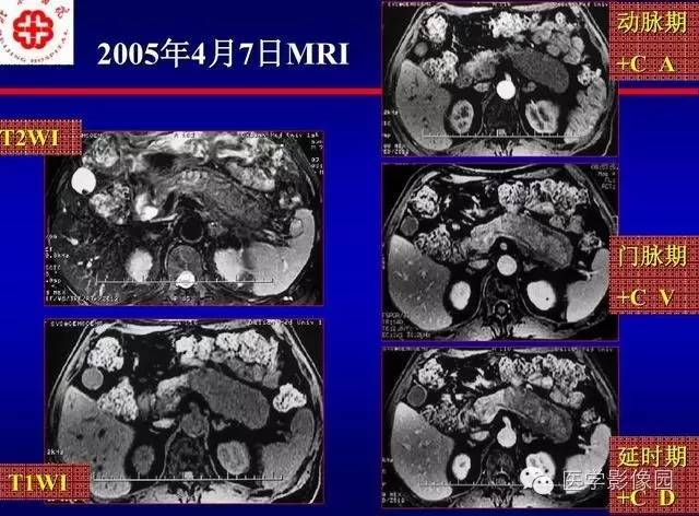 【PPT】胰腺少、罕见病变