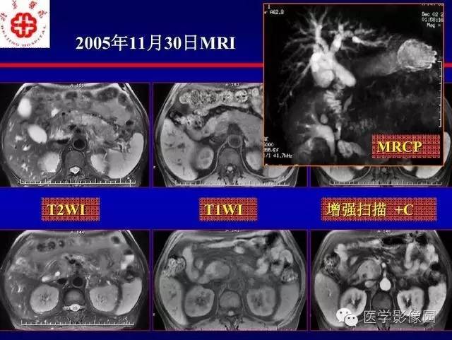 【PPT】胰腺少、罕见病变
