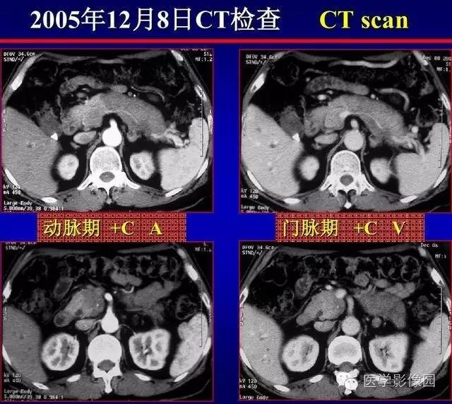 【PPT】胰腺少、罕见病变
