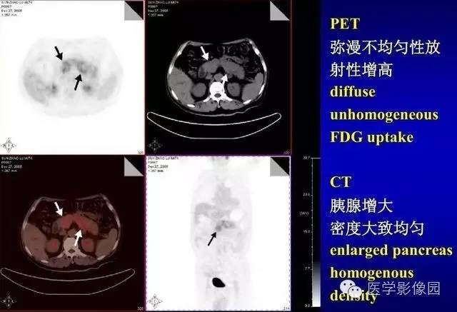 【PPT】胰腺少、罕见病变