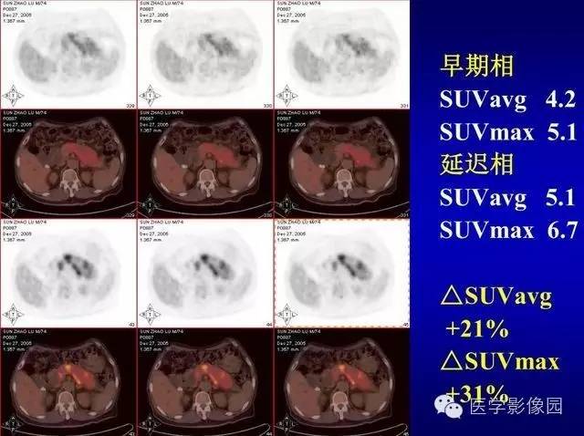 【PPT】胰腺少、罕见病变