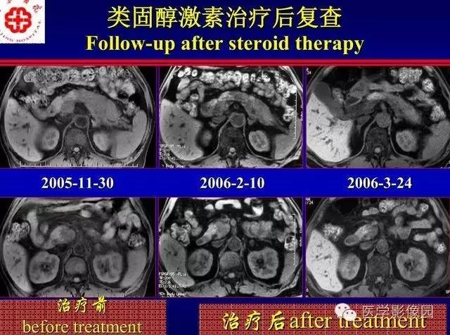 【PPT】胰腺少、罕见病变