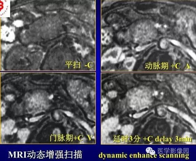 【PPT】胰腺少、罕见病变