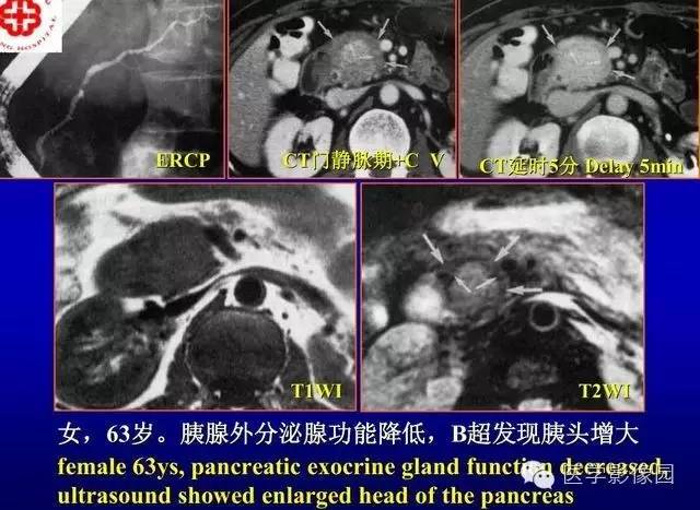 【PPT】胰腺少、罕见病变