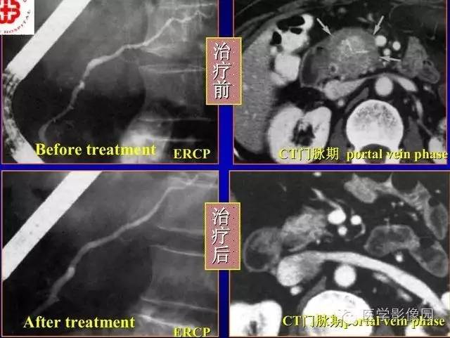【PPT】胰腺少、罕见病变