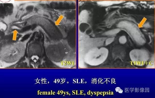 【PPT】胰腺少、罕见病变