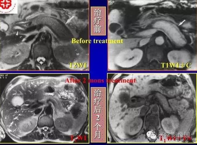 【PPT】胰腺少、罕见病变