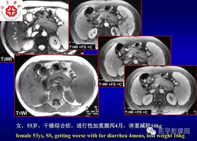 【PPT】胰腺少、罕见病变